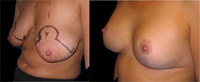 Bröstreduktion
